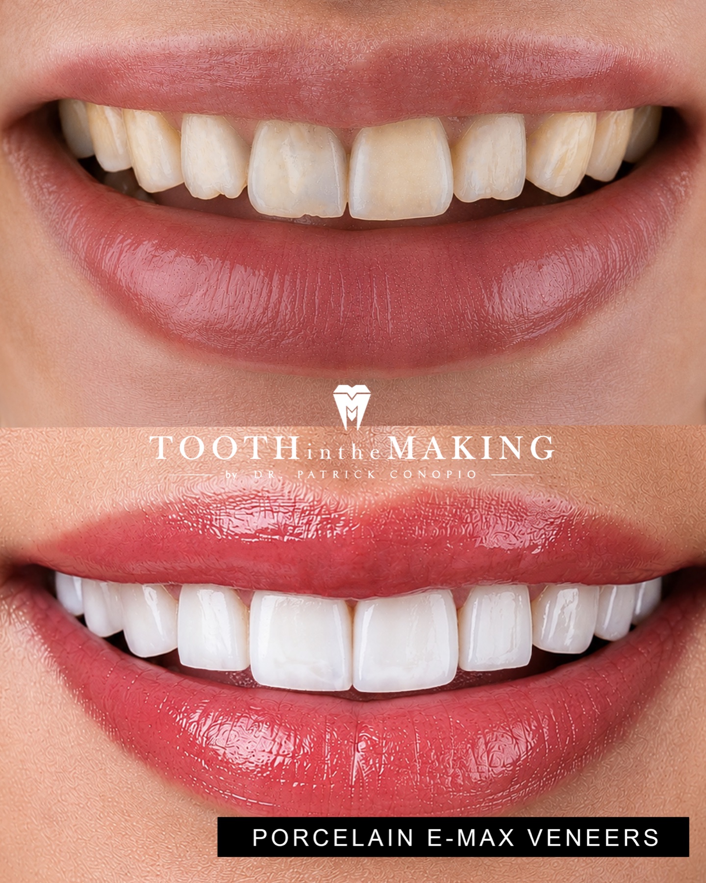 Before and after porcelain E-Max veneer transformation by Dr Patrick